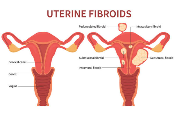 Fibroids