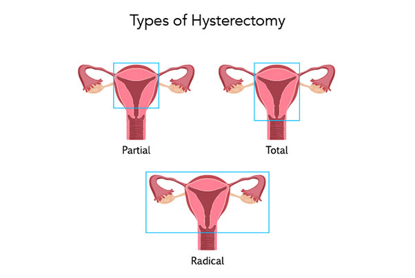 Hysterectomy