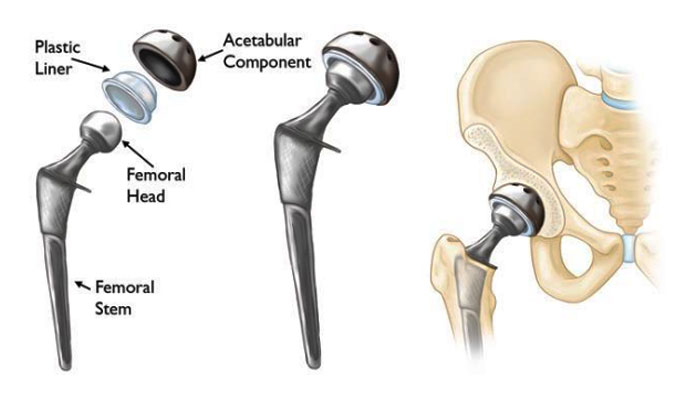 Hip Replacement