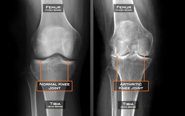 Knee Osteoarthritis