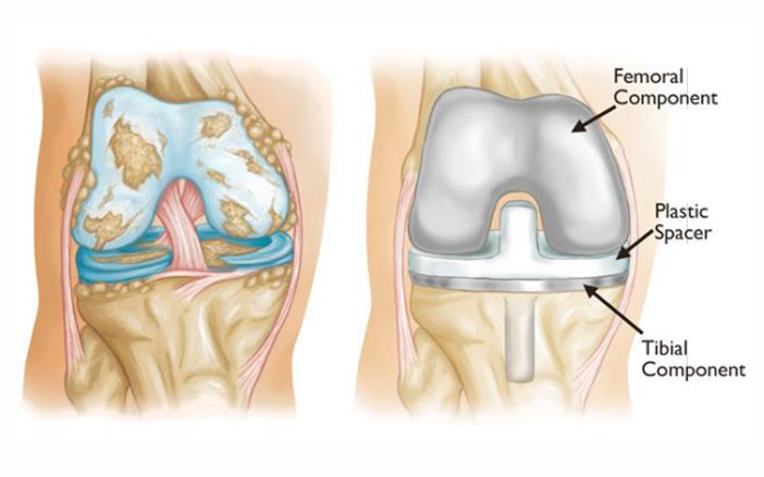 Knee Replacement