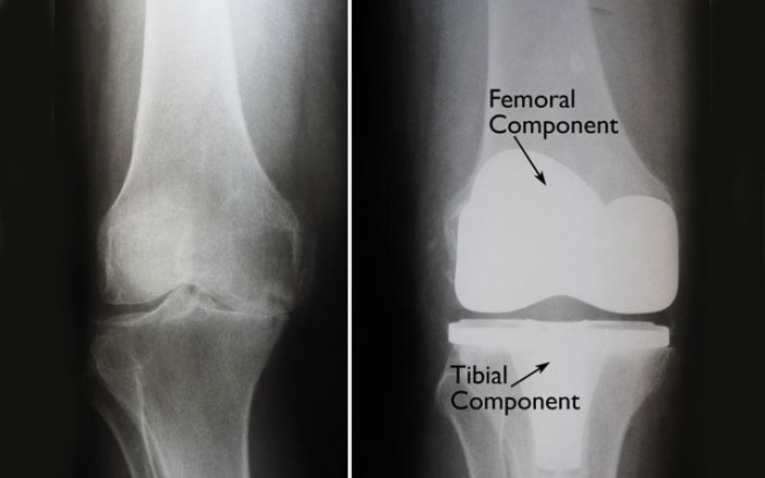 Knee Replacement