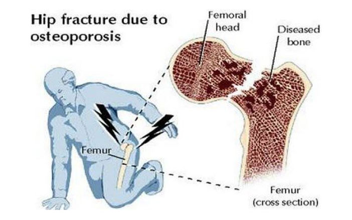 Osteoporosis