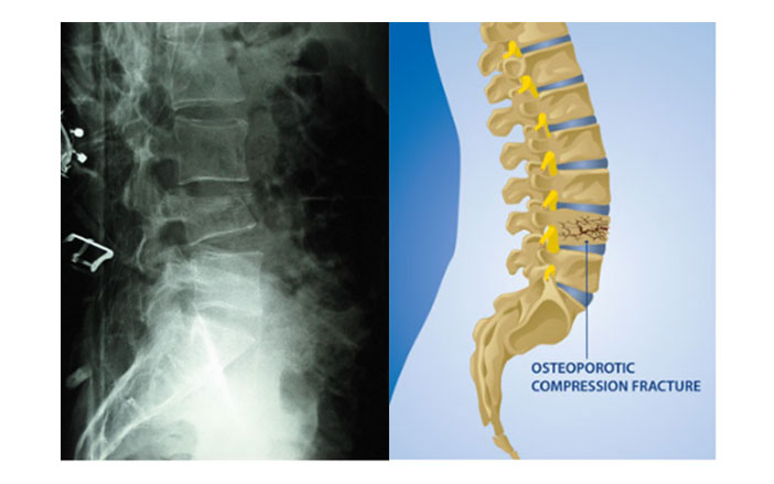 Osteoporosis