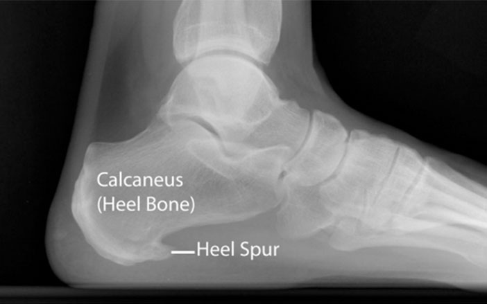 Plantar Fasciitis